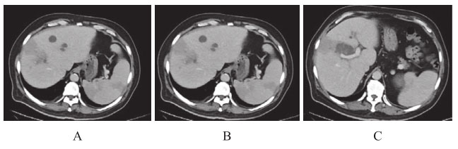 图3 腹部增强CT（第二次入院）